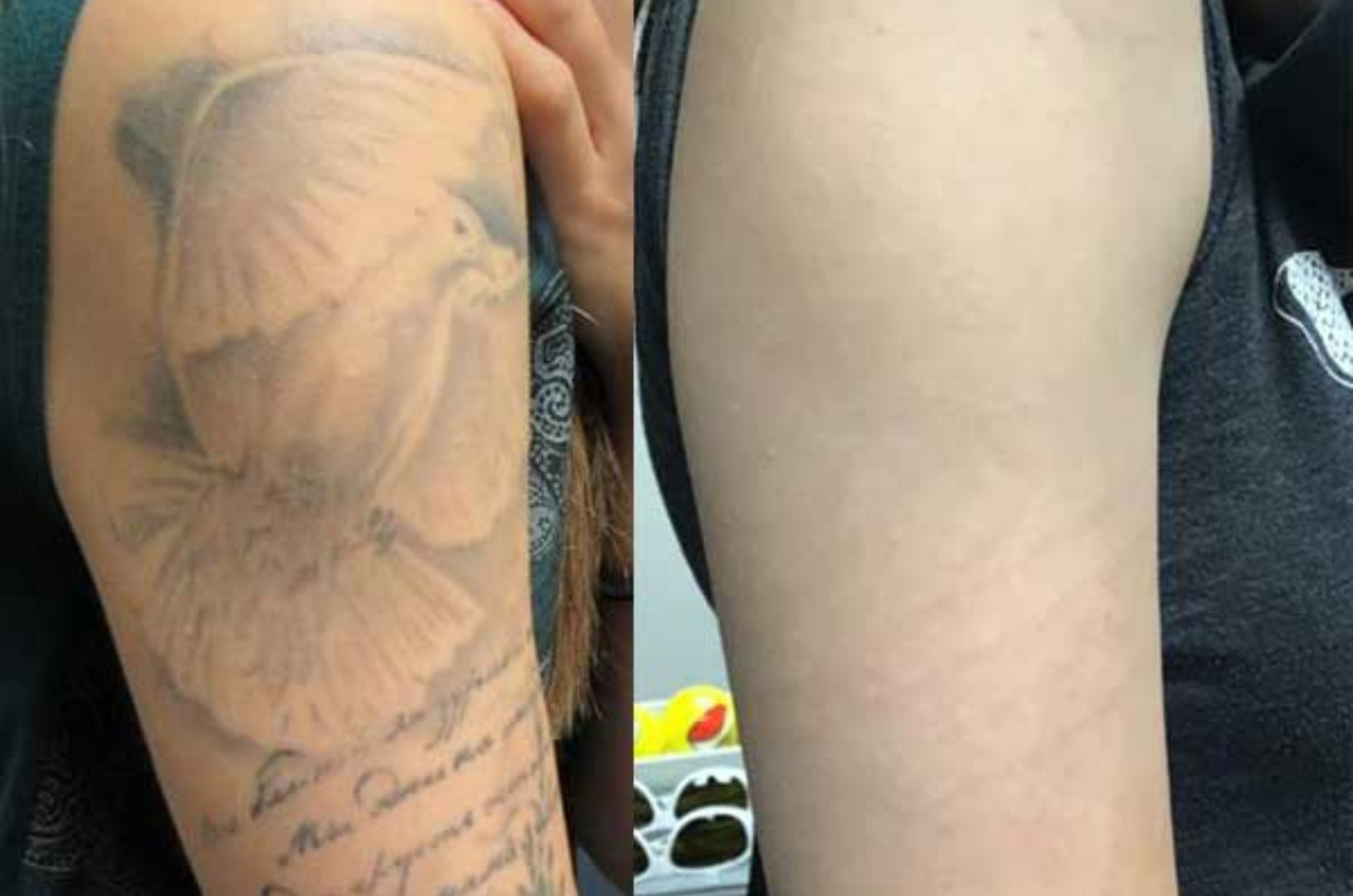 Tattoo Removal